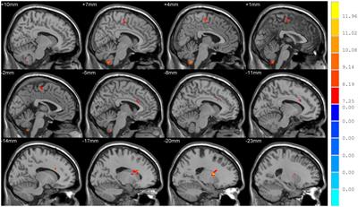 Distinct changes in global brain synchronization in different motor subtypes of Parkinson’s disease